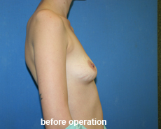 plastic-surgery-breast-augmentation